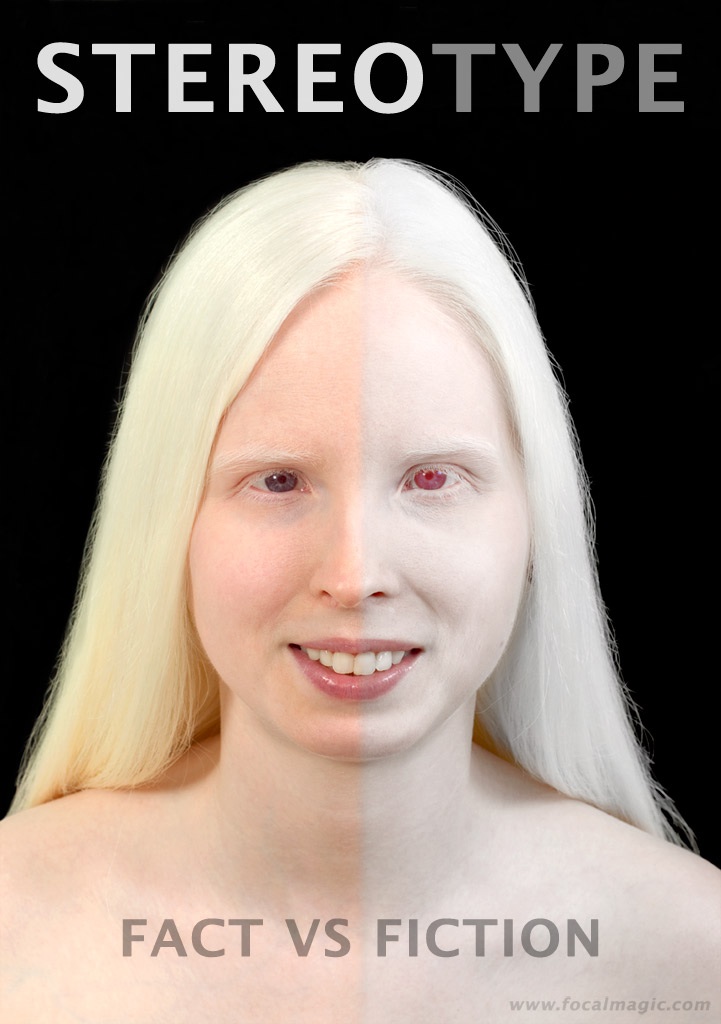 Albinos With Purple Eyes Have Partial Albinism But Pics