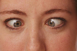 crosseyes