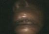 nose maggots