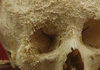 Bone Cancer Skull