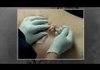 Cyst Removal Huge Popping Removal