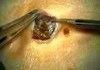 Giant Blackhead Cut Out