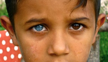 But More Often Then Not Two Eye Colors Is Heterochromia